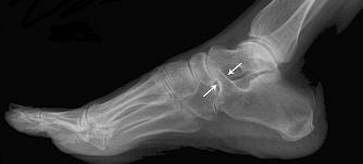 Tarsal Coalition